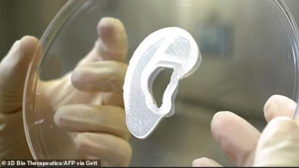 یک زن 20 ساله با یک گوش خارجی نو که به وسیله چاپ سه بعدی از سلول های خودش ساخته شده