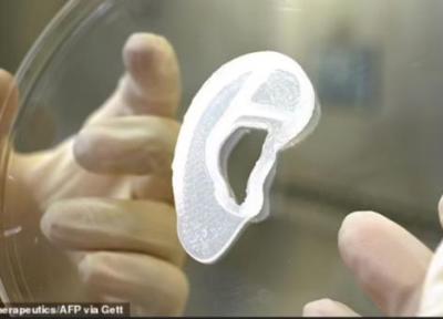 یک زن 20 ساله با یک گوش خارجی نو که به وسیله چاپ سه بعدی از سلول های خودش ساخته شده